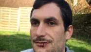 Sébastien, 26 ans, a été touché au visage par un tir de LBD.