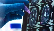 Le cas d'un patient atteint de la maladie d'Alzheimer intrigue les scientifiques.