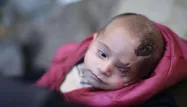 Un bébé syrien est devenu borgne après un raid du régime.