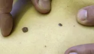 Des grains de beauté suspect, montrant un risque de mélanome, c'est-à-dire de cancer de la peau.