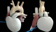 Comment fonctionne un cœur artificiel ?