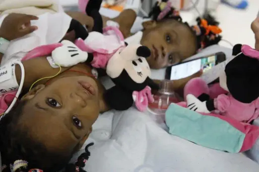 Les deux petites filles étaient reliées par l'abdomen.