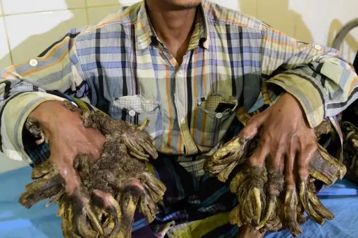 L'homme-arbre Abul Bajandar verrues