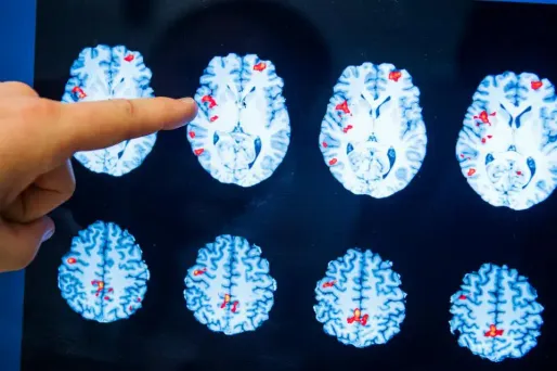 Le taux des crises dans le groupe traité avec le CBD a diminué de 39%.