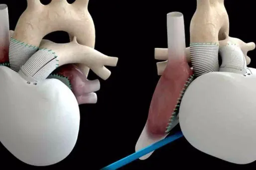 Carmat : feu vert pour de nouvelles implantations du cœur artificiel