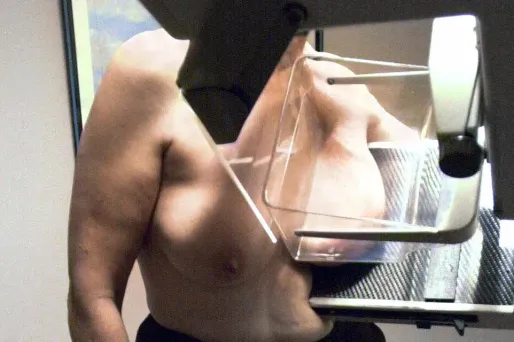 Cancer du sein : des frais trop chers pour les malades