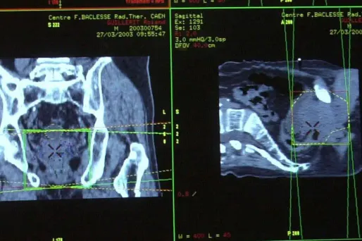 Le cancer, maladie qui effraie le plus les Français