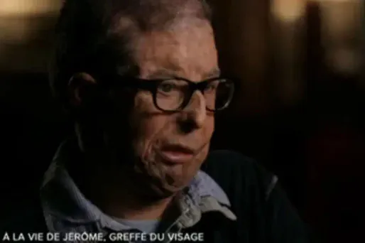 Le premier greffé total du visage sort du silence