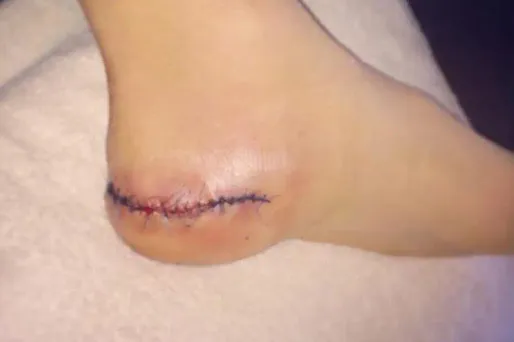 Athlé : la cicatrice impressionnante de Lavillenie