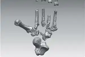 Sur le squelette, des traces de métastases prouvent que l'homme était atteint d'un cancer. (Photo d'illustration)