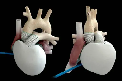 Cœur artificiel : a-t-on donné trop d’espoir aux malades ?