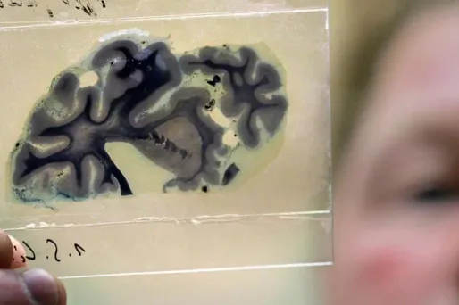 Dimanche a lieu la journée mondiale d'Alzheimer.