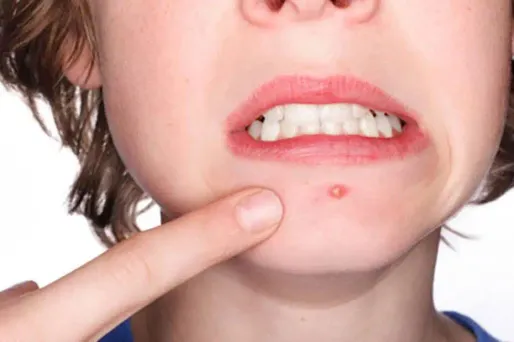 Ce pourrait être un produit anti-acné qui serait à l'origine du suicide de Jorda (Photo d'illustration).