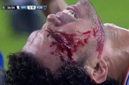 VIDÉO - Pepe se fait recoudre en plein match