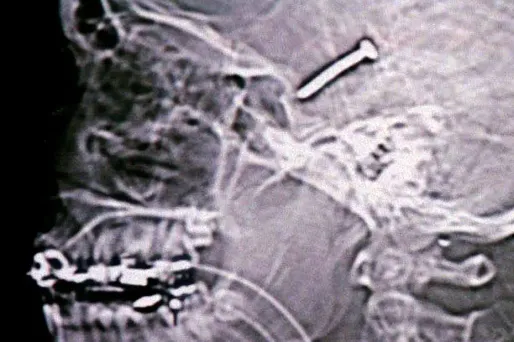 Scanner montrant un clou logé dans le cerveau d'un Israélien après un attentat-suicide en 2002.