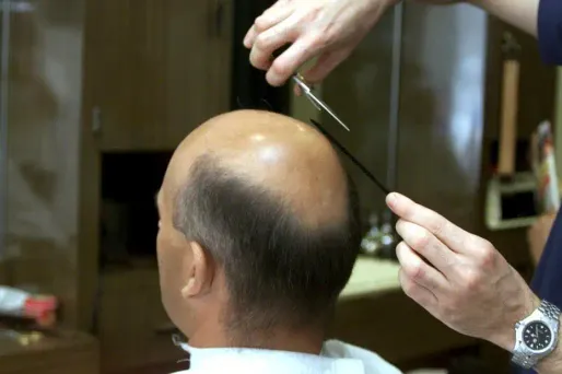 Bientôt la fin de la calvitie ?