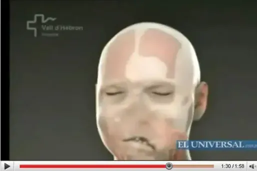 Première greffe totale du visage