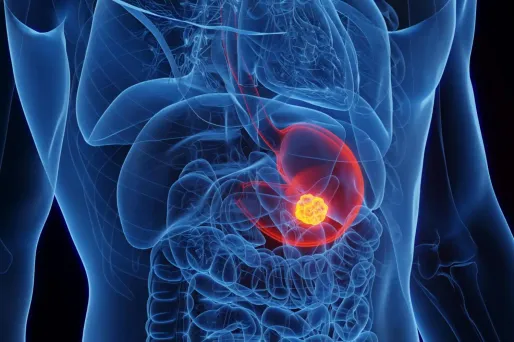 La bactérie «Helicobacter pylori» pourrait bientôt être responsable de millions de cancers de l'estomac